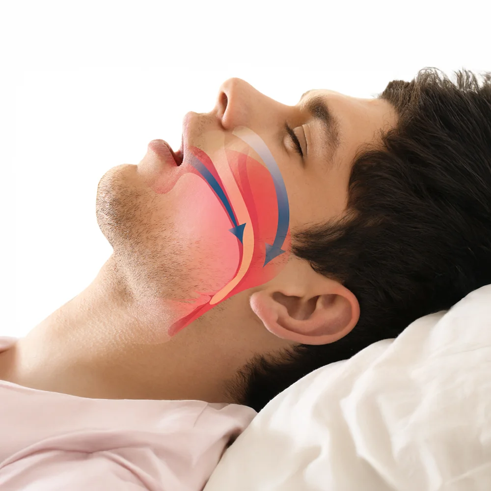 Sleep Apnea 1